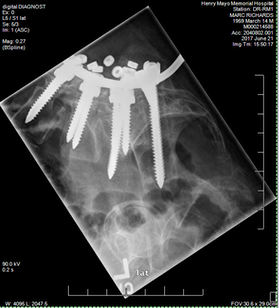 Xrays of back-marc richards 2